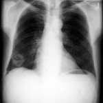X-ray lung image