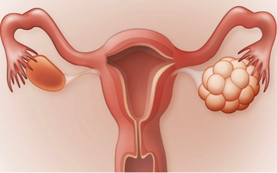 Polycystic Ovarian Syndrome (PCOS): Causes-Symptoms-Treatment